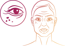 Rugas e marcas de expressão